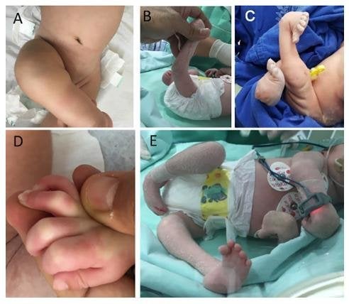 Infants with Zika-linked arthrogryposis are shown in the collage of photos.