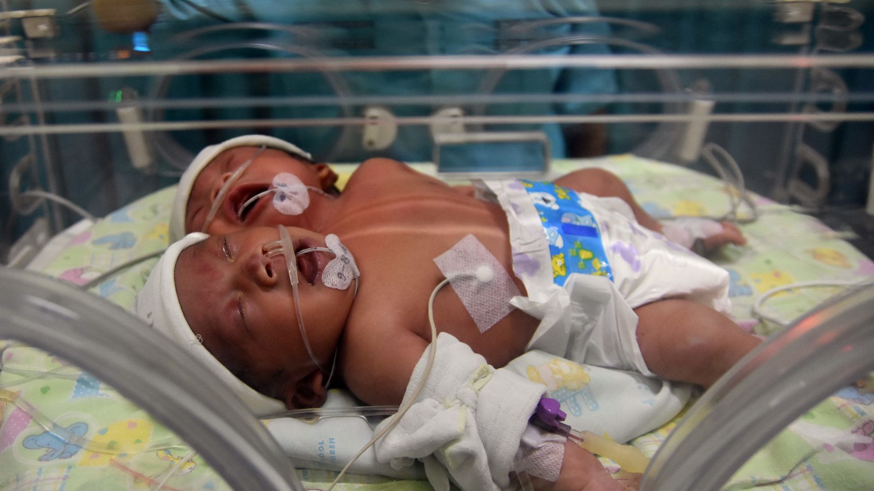 Two-headed Baby Reportedly Born In Indonesia 