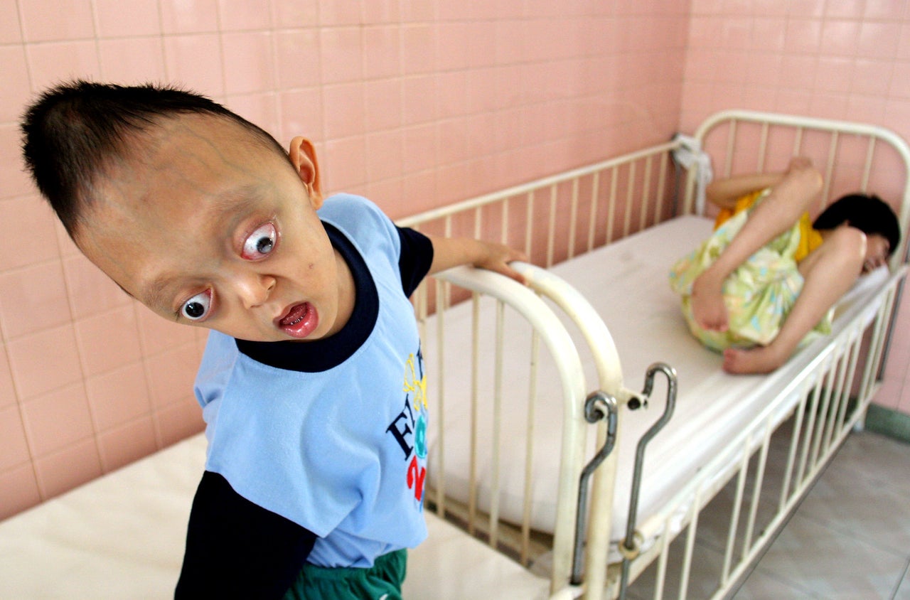 Agent Orange Victims Nguyen Xuan Minh (L), and Nguyen Thi Thuy Giang, of Hanoi are seen at the Peace Village in Ho Chi Minh city on Sept. 15, 2006.