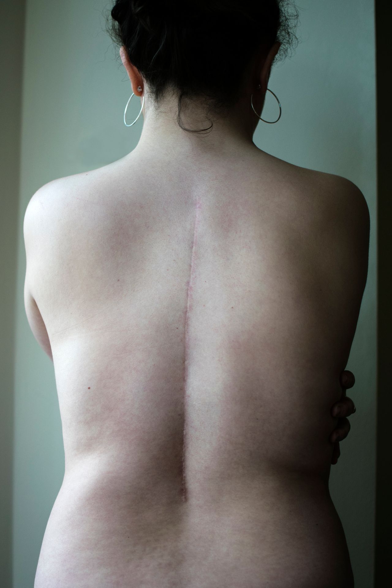 Floss, spinal fusion. February 14, 2011