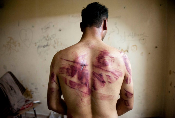 A Syrian man shows marks of torture on his back, after he was released from regime forces, in Aleppo in August 2012.