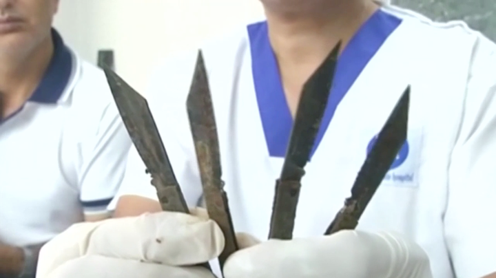 A doctor holds up four knives that are said to have been removed from a man's stomach in northern India.