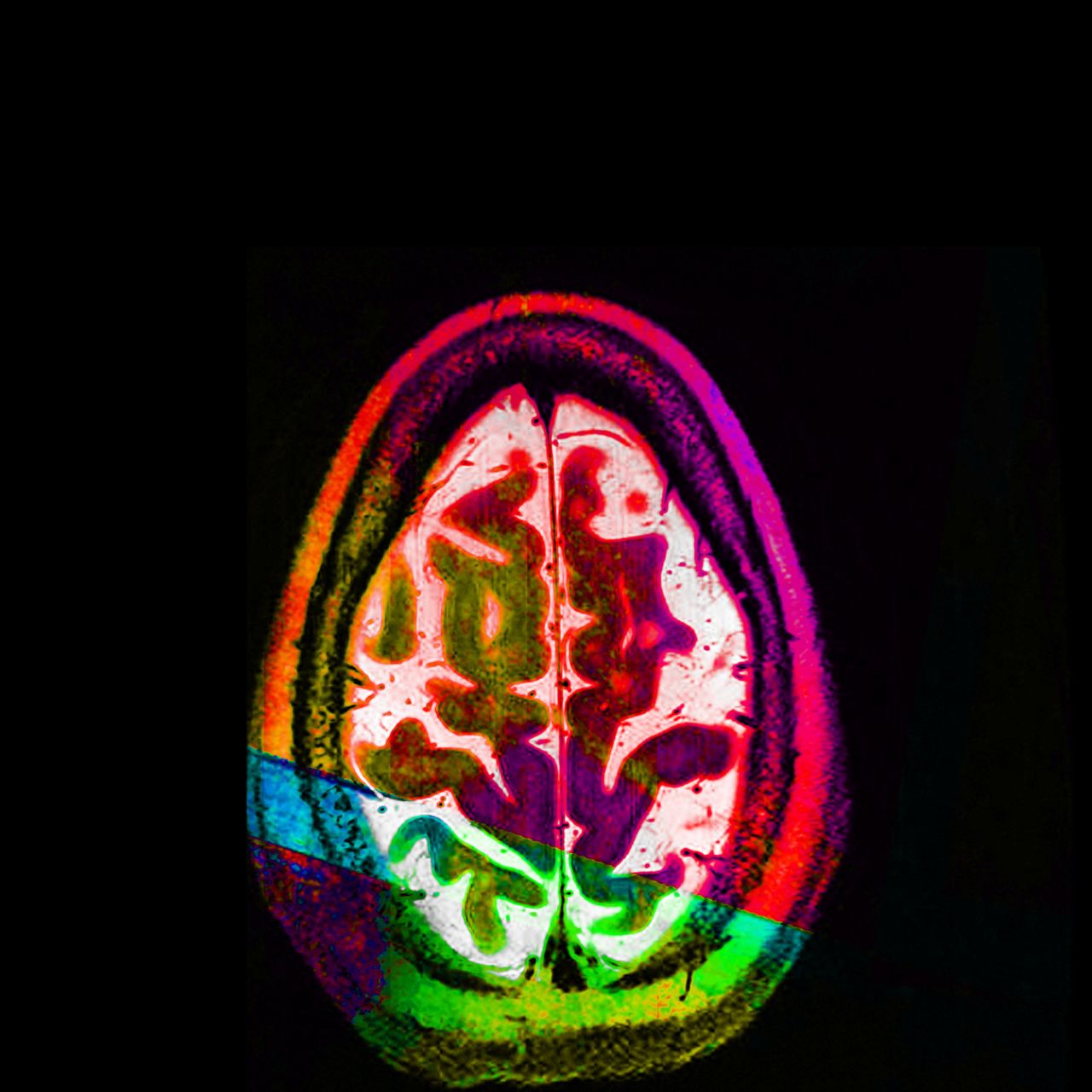 "Good Egg" (or an axial MRI view of the artist's brain).