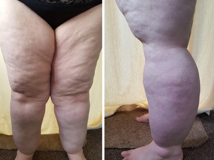 Victoria's legs weigh four stone each.