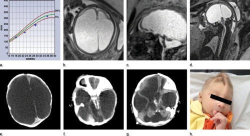 <em>These photos show the abnormal development of a fetus born to woman with a confirmed case of Zika virus infection. The brain is affected by extreme, asymmetric ventriculomegaly, which is when the ventricles of the brain swell up with fluid. </em>