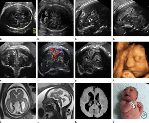 The photos above show the development of a fetal brain over the course of the pregnancy. While the fetal head circumference started out normally at 12 weeks and 16 weeks, another scan at 22 weeks showed that it had decreased to the 10th percentile of growth.