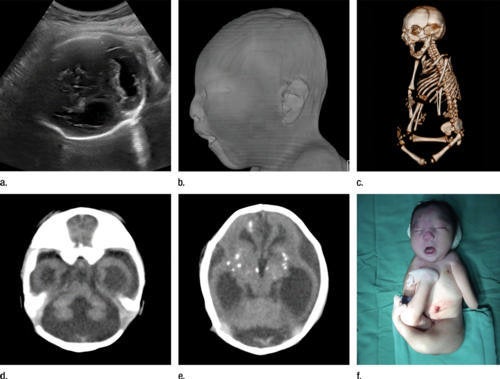 These photos show the joint contractures caused by exposure to Zika virus in the womb. 