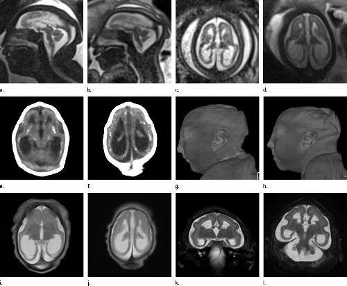 A series of images captured in a twin pregnancy affected by Zika virus.