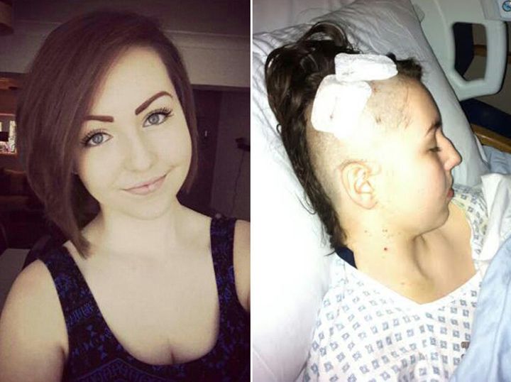 Amanda Day before her diagnosis and after having surgery to remove the tumour.