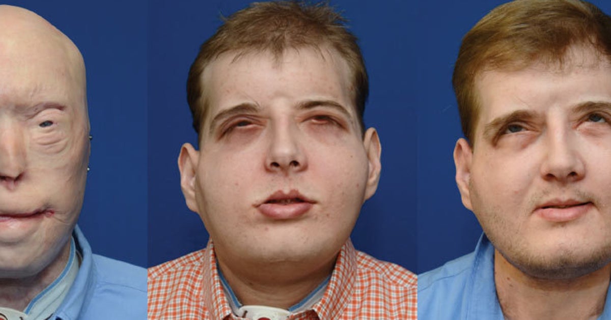 Incredible Transformation Of Face Transplant Recipient Who Feels 'Normal' For First Time In 15 Years