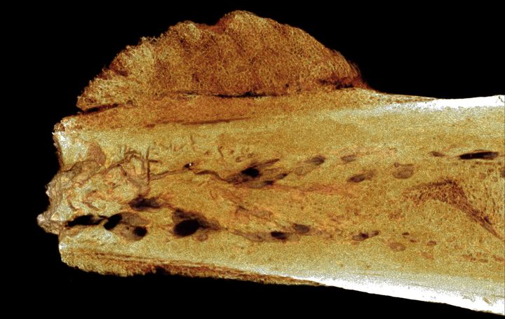 This micro-CT image shows a tumor in an ancient toe bone from a human relative.