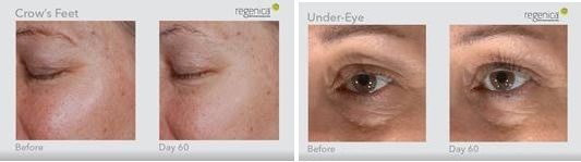 Regenica Revitalizing Eye Cream Before and After photos.