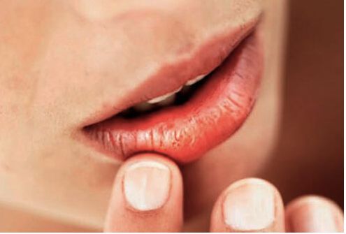 Chapped lips may be a sign of a chronically dry mouth