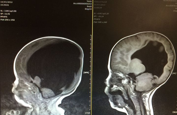 The scan on the left was when Noah was just born showing 2% brain function compared to the scan on the right which shows that his brain has almost completely full function.