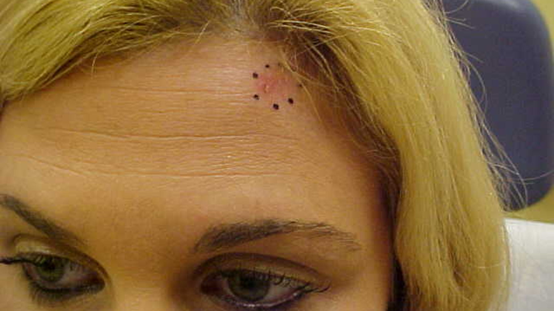 Skin Cancer On Face What Does It Look Like - vrogue.co