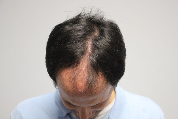 Example of androgentic alopecia