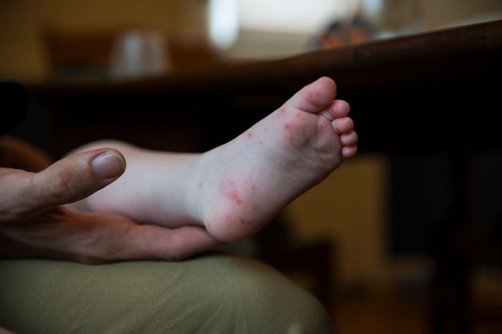 The disease, which causes fever, mouth sores and skin rashes, like the one seen here, typically affects infants and young children.