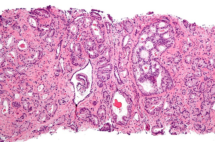 Image from https://en.wikipedia.org/wiki/Prostate_cancer