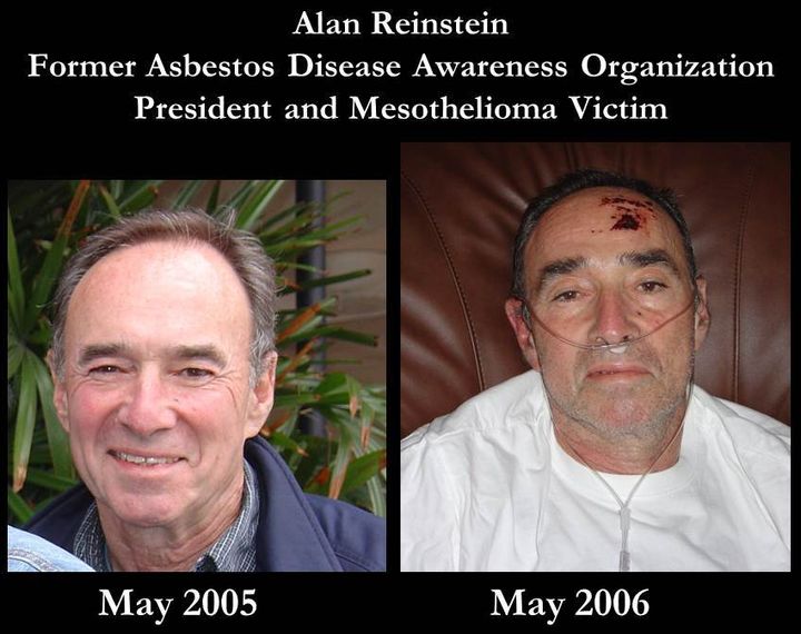 Mesothelioma victims often see their health decline rapidly, and seemingly out of nowhere. 