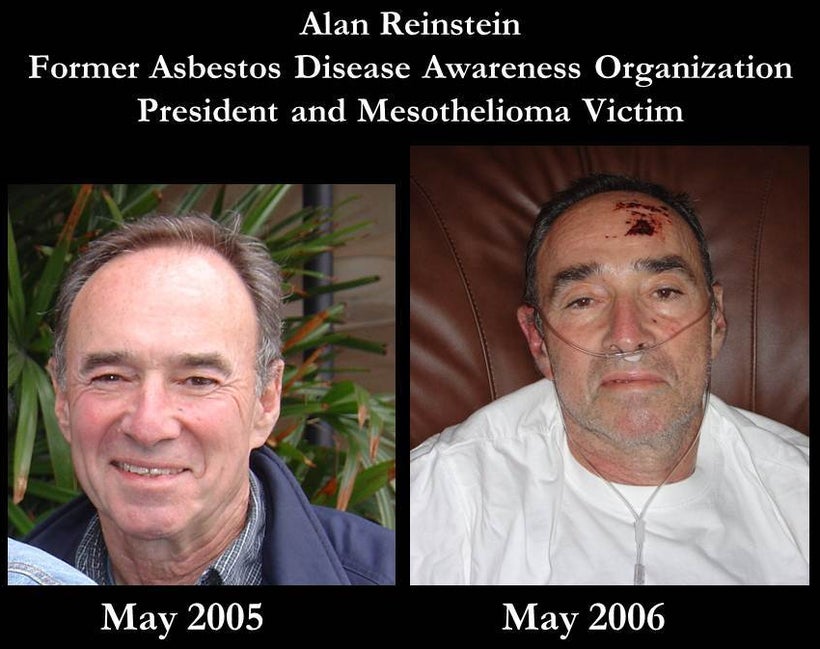 Mesothelioma victims often see their health decline rapidly, and seemingly out of nowhere.