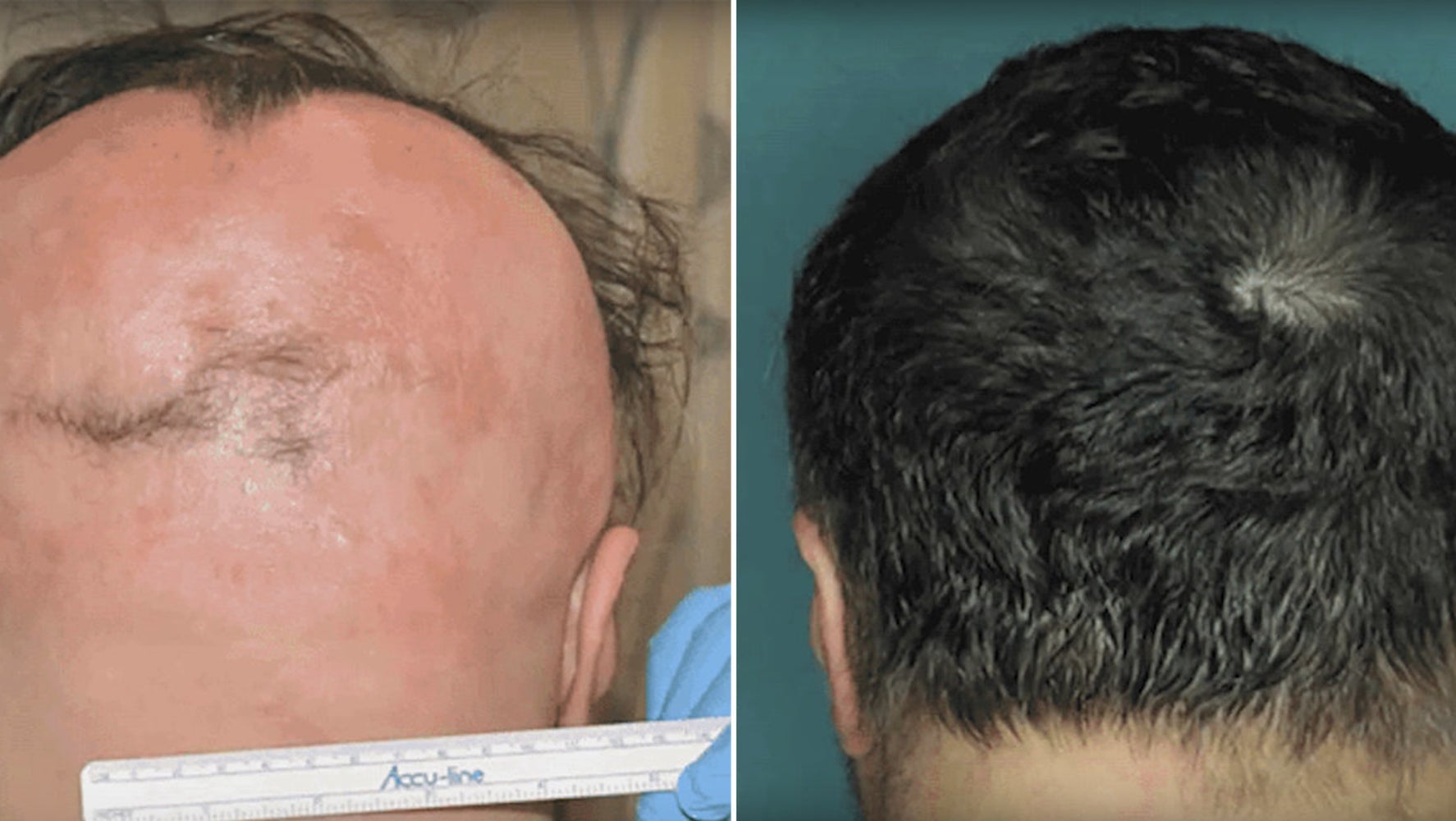 Cure For Baldness: Drug Restores Hair In 75% Of Alopecia Areata Patients | HuffPost UK Life Cure For Baldness: Drug Restores Hair In 75% Of Alopecia Areata Patients | HuffPost UK Life