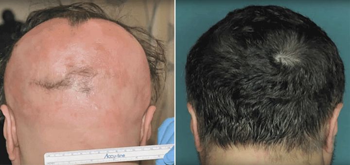 One of the patients' hair before and after treatment with the drug. 
