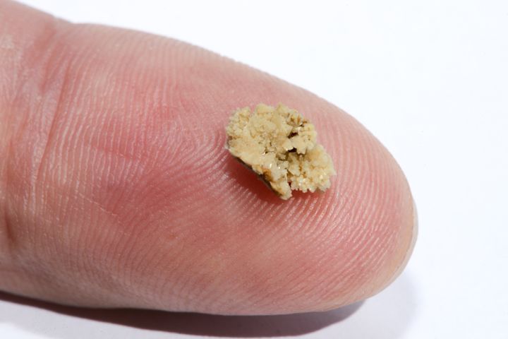 Kidney stones that are greater than 6 mm in diameter have about a 1 percent chance of spontaneously passing without intervention. The one pictured here is 8 mm.