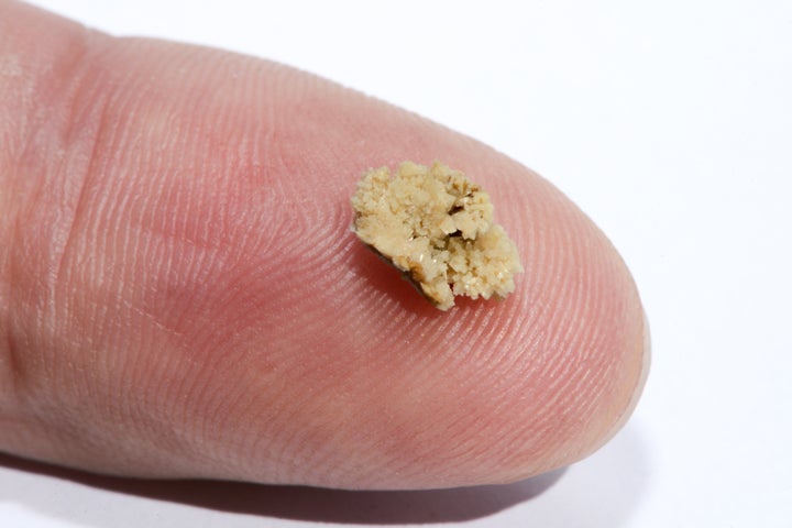 Kidney stones that are greater than 6 mm in diameter have about a 1 percent chance of spontaneously passing without intervention. The one pictured here is 8 mm.