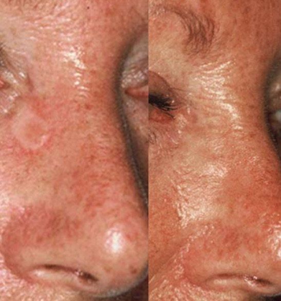 A picture from study author Dr. Rick van de Langenberg shows the difference a medical tattoo can make when hiding a scar or skin graft