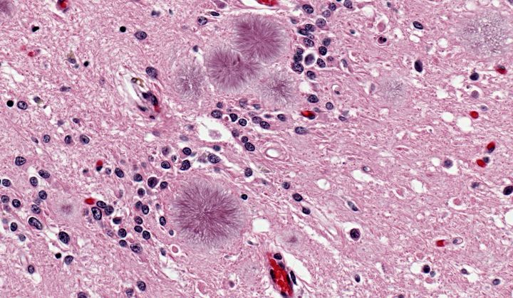 Brain tissue revealing the presence of typical amyloid plaques found in a case of variant Creutzfeldt-Jakob disease