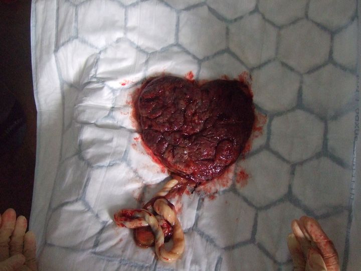 The heart-shaped placenta.