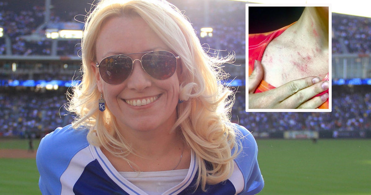 Woman's Allergy To Water Causes A Rash After She Showers, Cries Or Goes