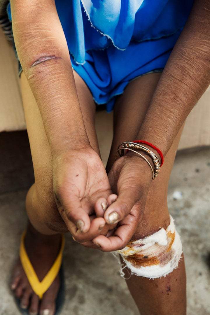 A woman shows us her scars from daily torture