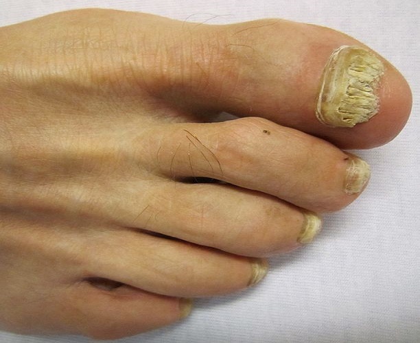 Cure Pain From Toenail Fungus Infection