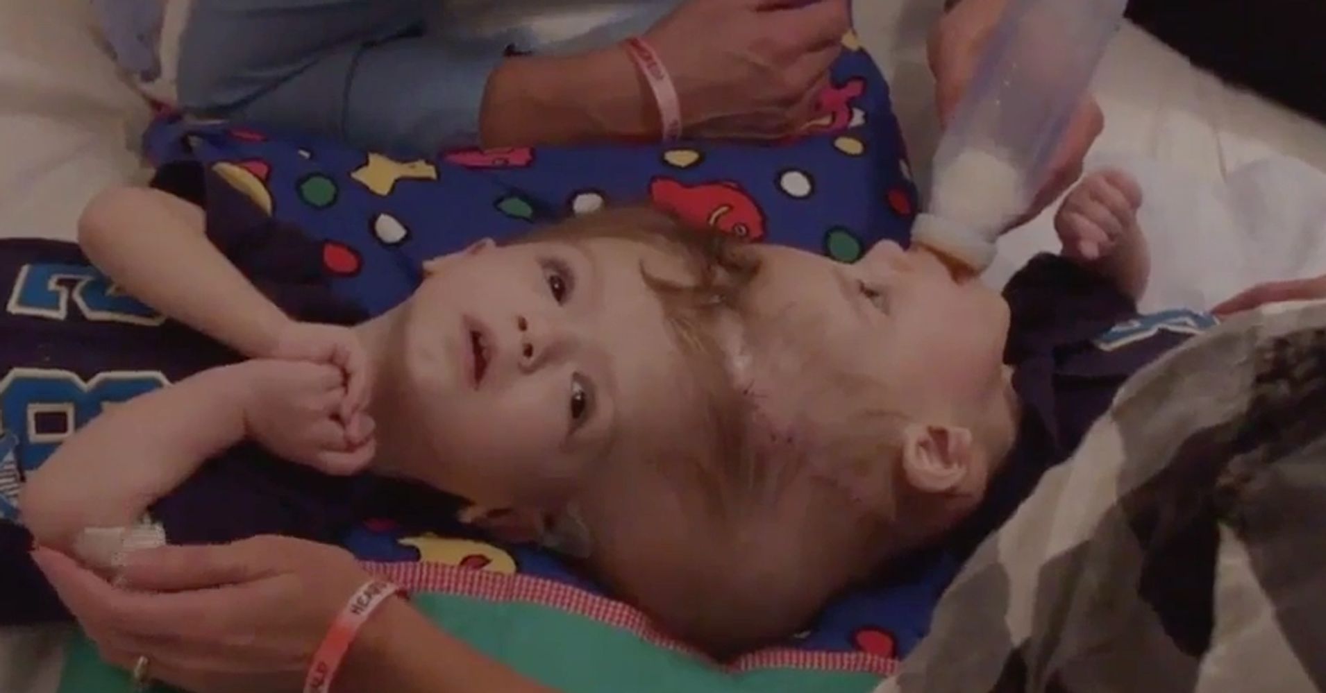 Conjoined Twins Jadon and Anias McDonald Successfully Separated HuffPost