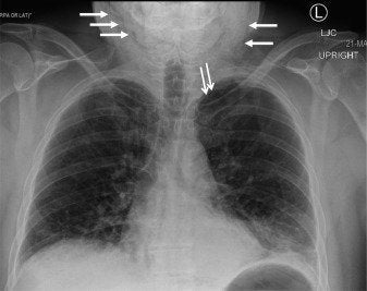 A chest x-ray of the ghost pepper patient.