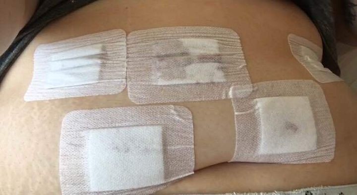 My stomach after the removal surgery.