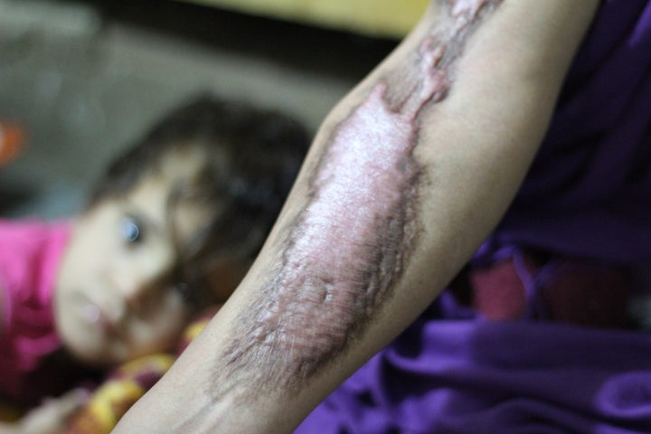A woman shows her scars and burns months after she was scalded by a mustard agent that ISIS launched in the town of Taza