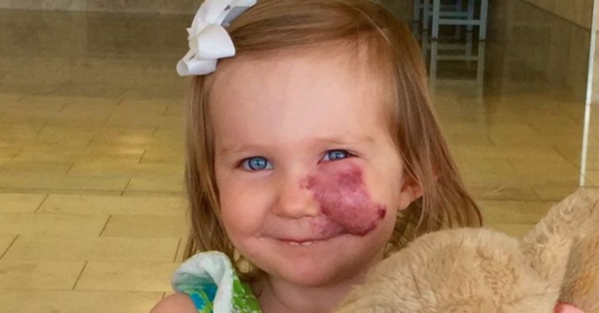 Toddler With Large Facial Birthmark Perfectly Prepared For Kids