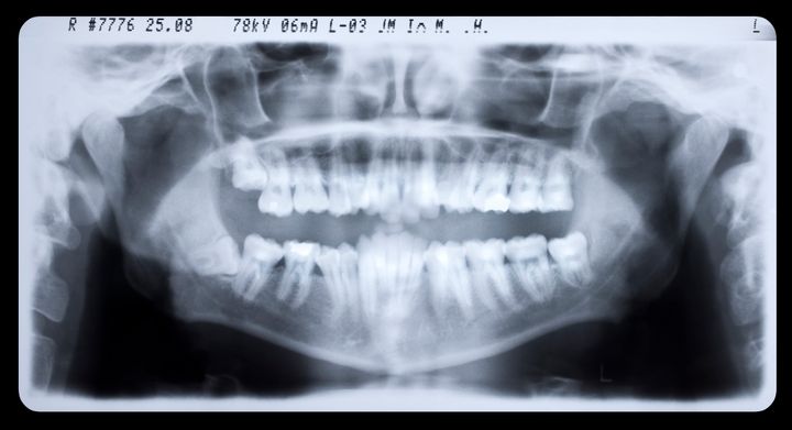 X-ray images are used during dental age checks to identify the development stage of teeth