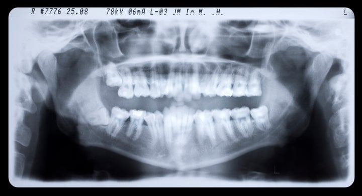 X-ray images are used during dental age checks to identify the development stage of teeth