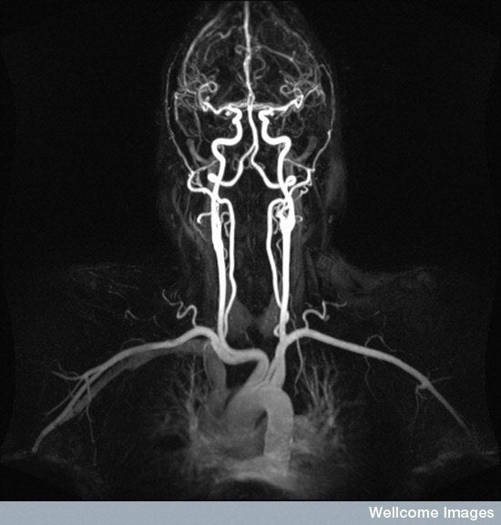 Magnetic Resonance Angiogram of the Carotid and Vertebral Arteries