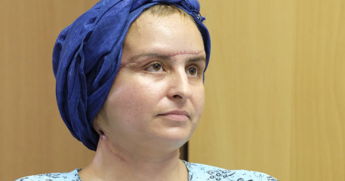 Face Transplant Recipient Looks Unrecognisable Two Years After Life