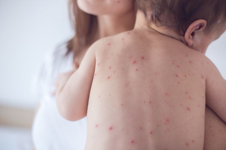 Babies less than a year old who contract measles have about a 1 in 600 risk of acquiring the fatal neurological disorder subacute sclerosing panencephalitis, according to new research.