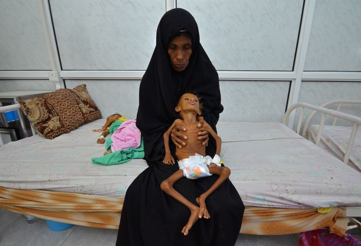 This boy, 6, is held by his mother as she sits on a bed at a malnutrition intensive care unit at a hospital in the Red Sea port city of Hodaida, Yemen in Sept. 2016.