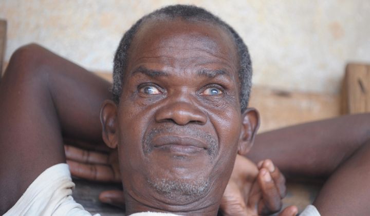 A blind man suffering from river blindness, caused by a parasitic worm, spread by the bite of an infected blackfly, in the Ivorian town of Kouadioa-Allaikro, 2008. Most infected persons are in Africa, and the disease is found most frequently in rural agricultural villages that are located near rapidly flowing streams.