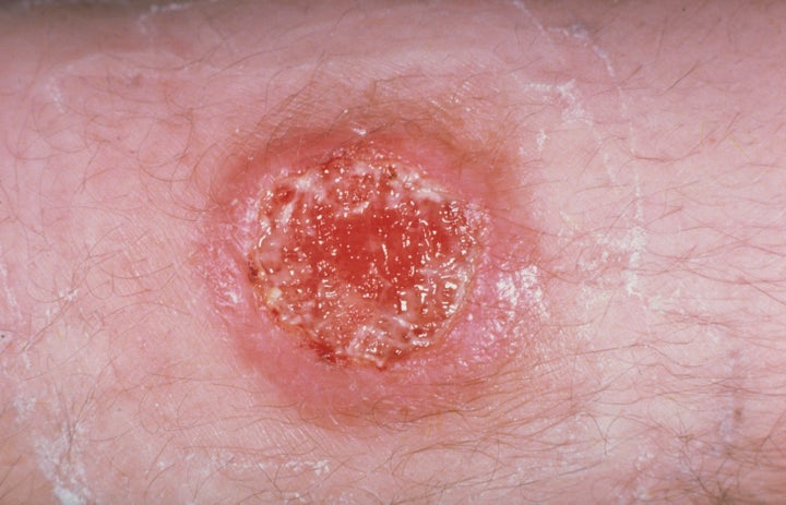 Leishmaniasis, caused by an intracellular protozoal parasite. The disease is transmitted by the bite of a sand fly.