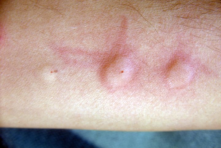 Man's arm showing positive skin test for echinococcosis.