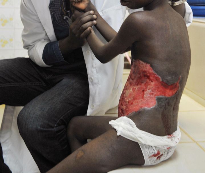 A doctor gives comfort to a child suffering from Buruli ulcer at a clinic in Ivory Coast, on Sept. 12, 2009.