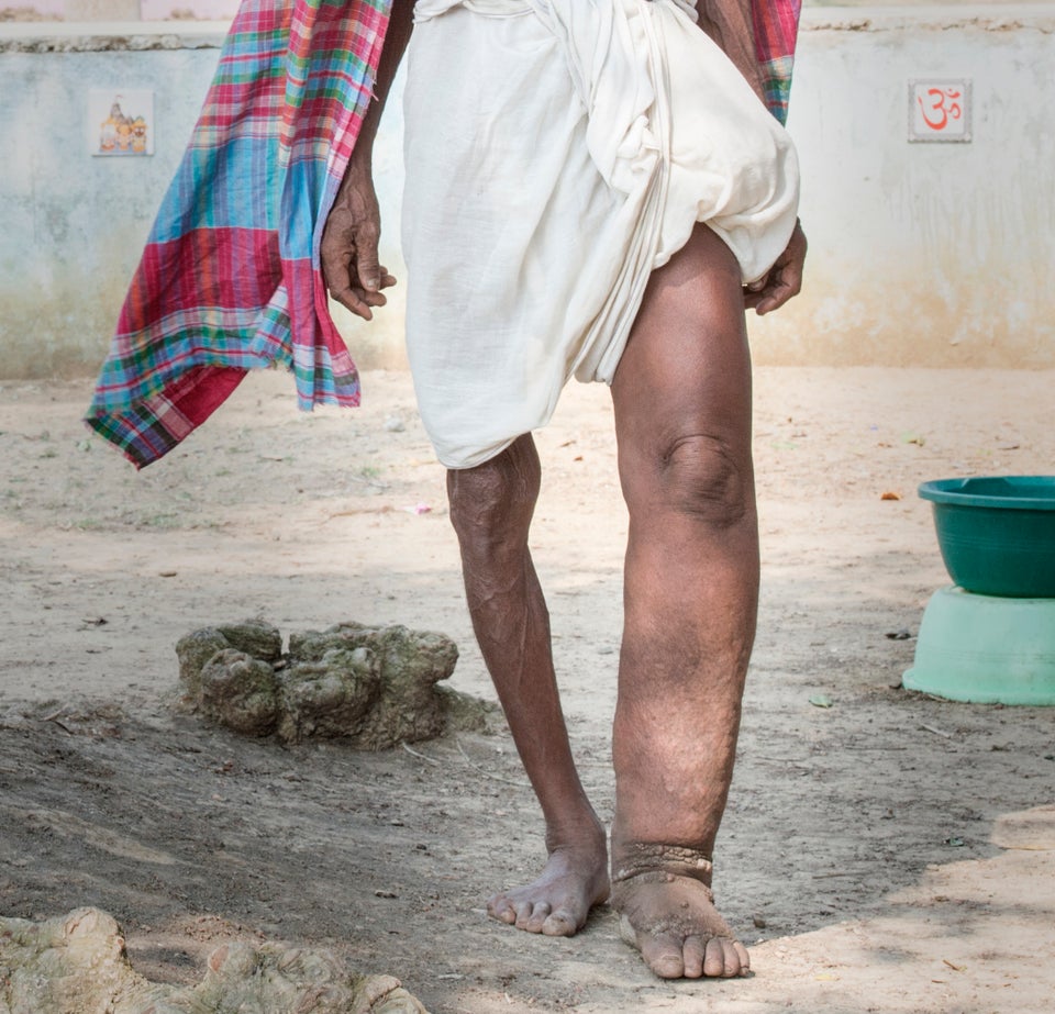 Elephantiasis Symptoms